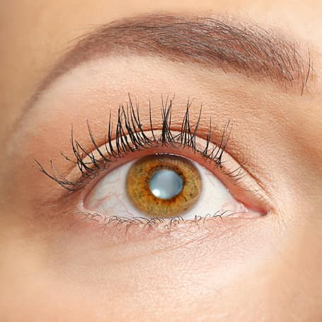 Cloudy Eye Lens Cloudy Eye Lens